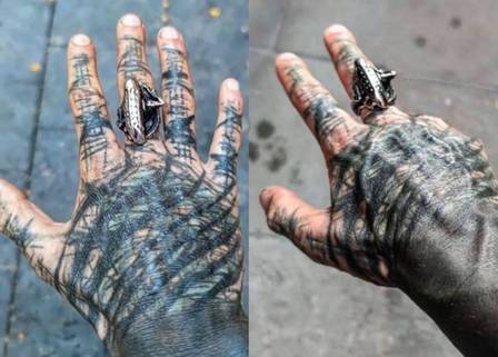 antes e depois de mão que teve dedos amputados