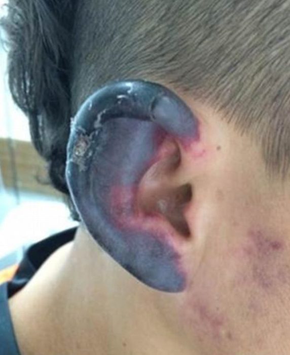 Homem ficou com a orelha preta após uso frequente da cocaína