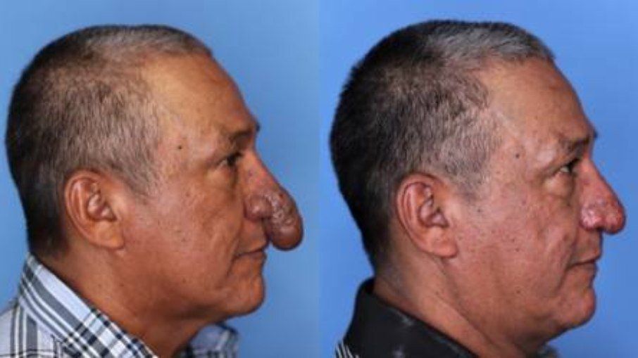 Homem com nariz deformado ganha cirurgia gratuita de médico que se solidarizou com a situação