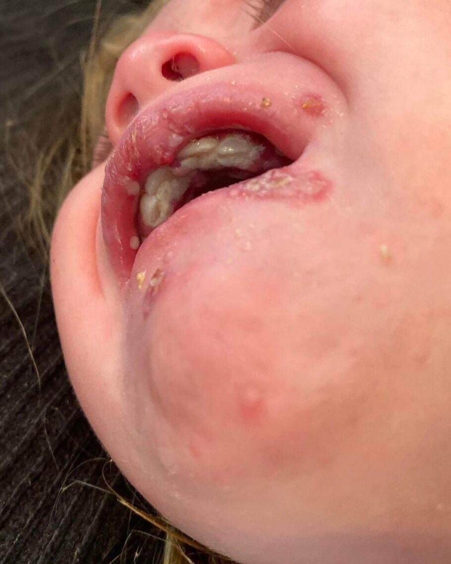 Bebê fica com a boca cheia de ferida após receber um beijo de um adulto