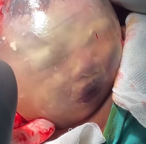  Bebê dentro do saco amniótico