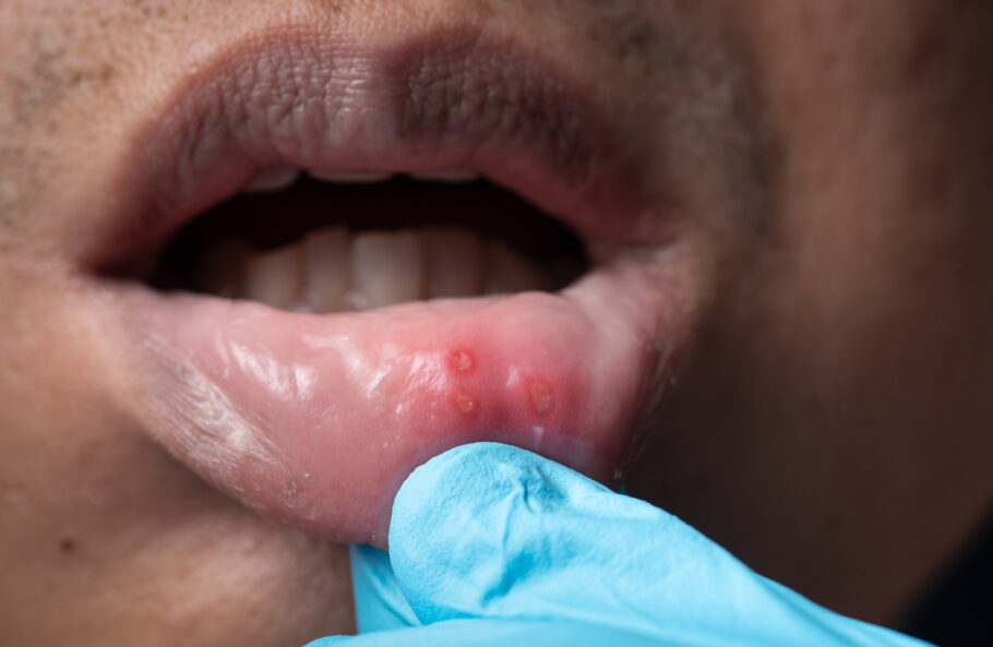 Estomatite pode causar aftas em várias partes da boca