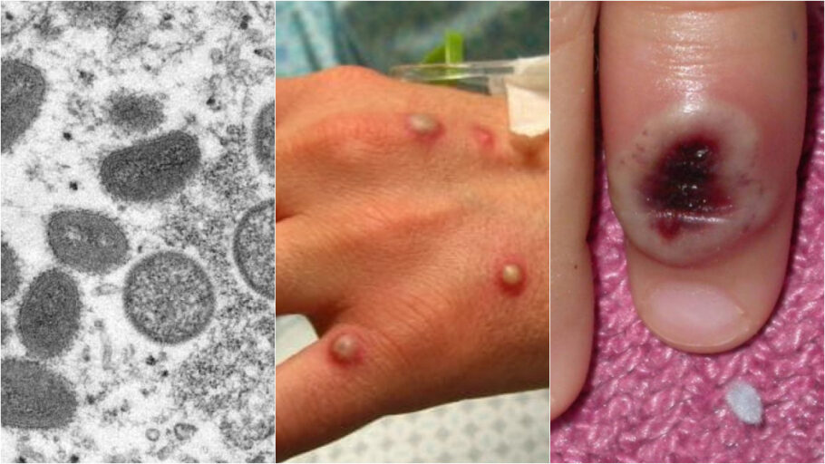Erupções na pele são sinais da doença