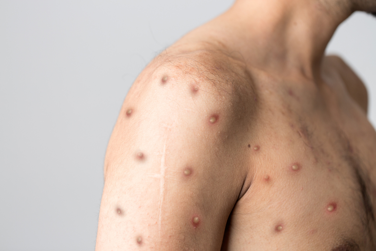 Doença viral rara transmitida pelo contato próximo com uma pessoa infectada e com lesões de pele