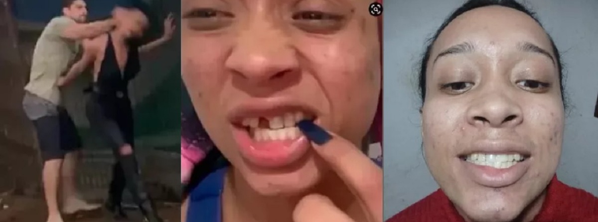 Trans que teve dente quebrado por homem ganha reconstrução