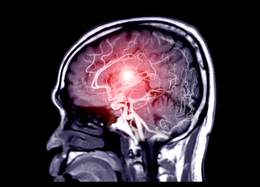Aneurisma pode ser detectado com ressonância magnética ou tomografia