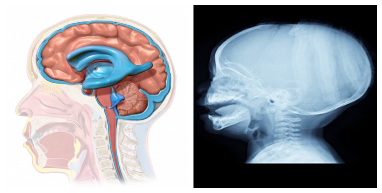 A hidrocefalia é causada pela obstrução do fluxo normal de LCR