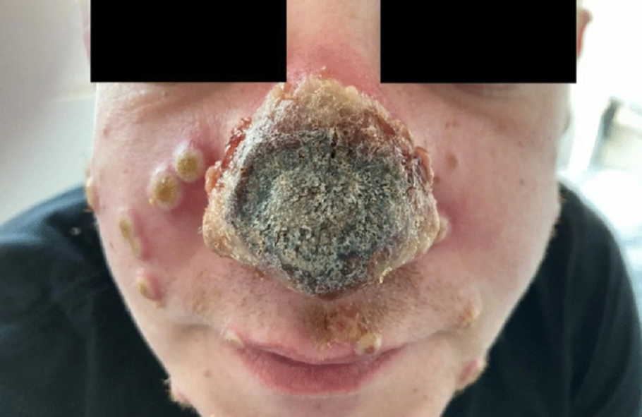 Tecido do nariz necrosou após ferida causada pelo vírus monkeypox