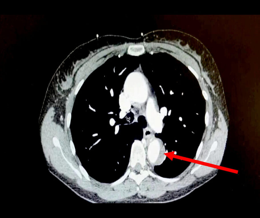 Tomografia computadorizada do tórax mostrando hematoma intramural da aorta