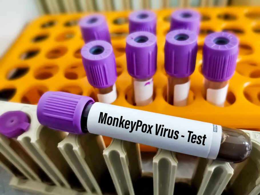 Monkeypox é detectado em pessoas sem sintomas, o que levanta a hipótese de disseminação assintomática