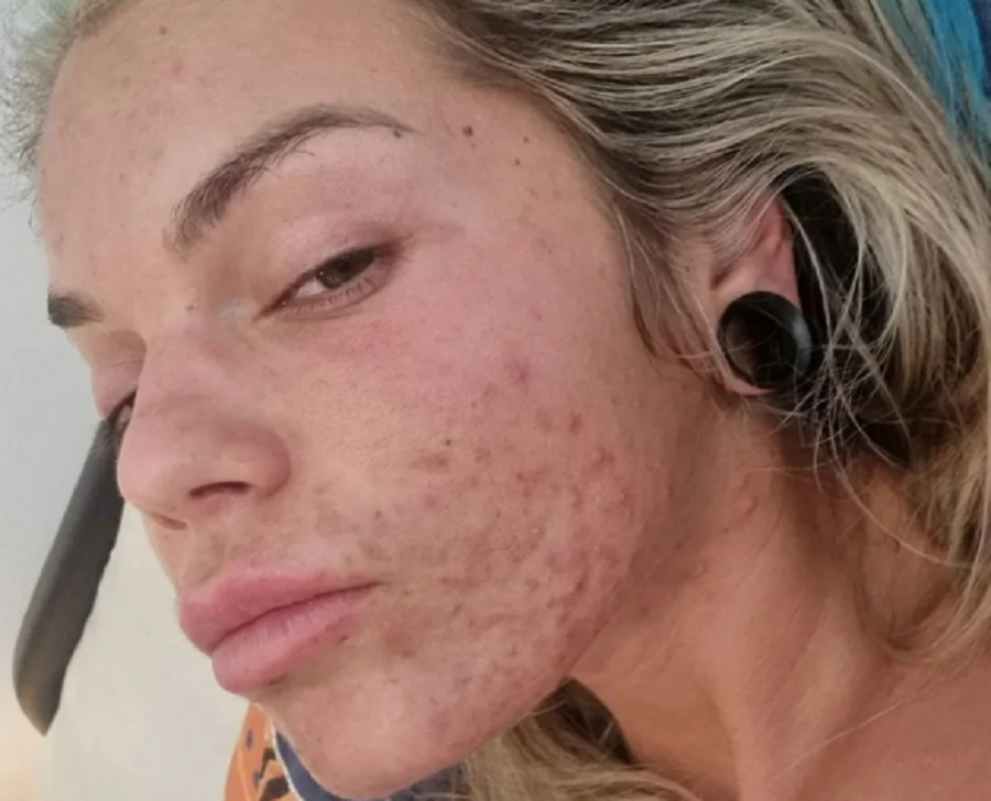 Educadora física sofria com acne severa