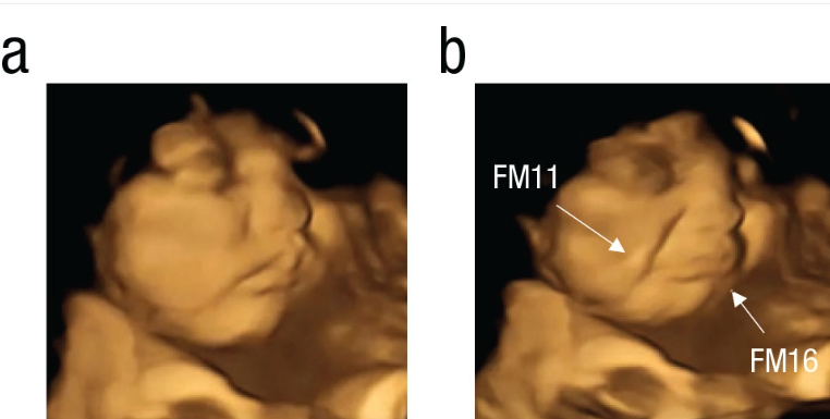 Cara de choro de um feto exposto à couve