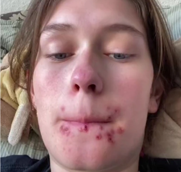 Dinamarquesa diz que teve herpes grave após dar o primeiro beijo em um ano