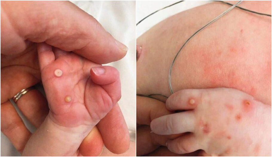 Bebê recém-nascido é diagnosticado com varíola dos macacos