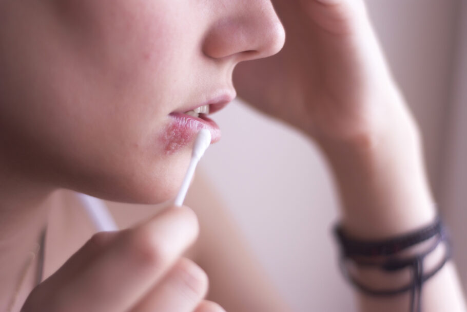 Vírus do beijo pode desencadear esclerose múltipla, segundo estudo de Harvard