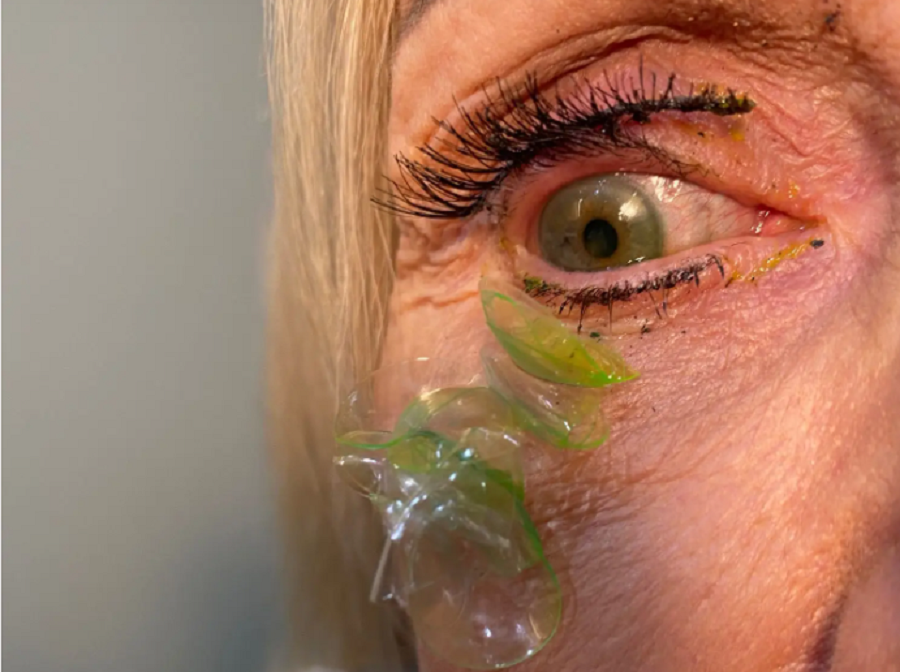 A video that removes 23 lenses from the patient’s eye, a virus spreads