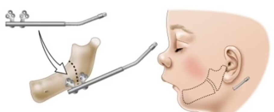 Dispositivo chamado distrator de mandíbula faz a correção óssea