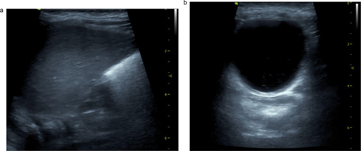  Em uma das ultrassonografias um dos rins do meninno não foi detectado