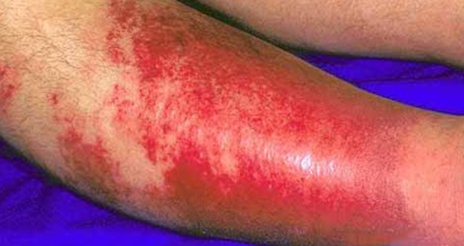A erisipela é uma infecção bacteriana que afeta a derme superior (camada superior da pele) e os vasos linfáticos dentro da pele