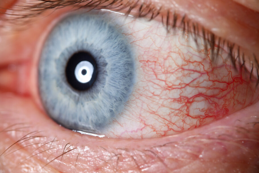 A condição é causada quando os vasos sanguíneos dos olhos se rompem