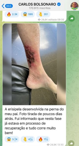 Foto seria da perna de Bolsonaro