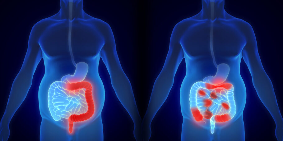 A doença de Crohn e a colite ulcerativa são doenças inflamatórias intestinais