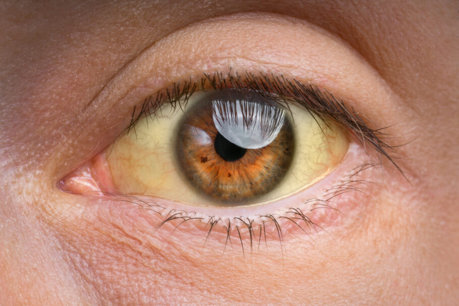 Olhos amarelados fazem mulher descobrir câncer terminal
