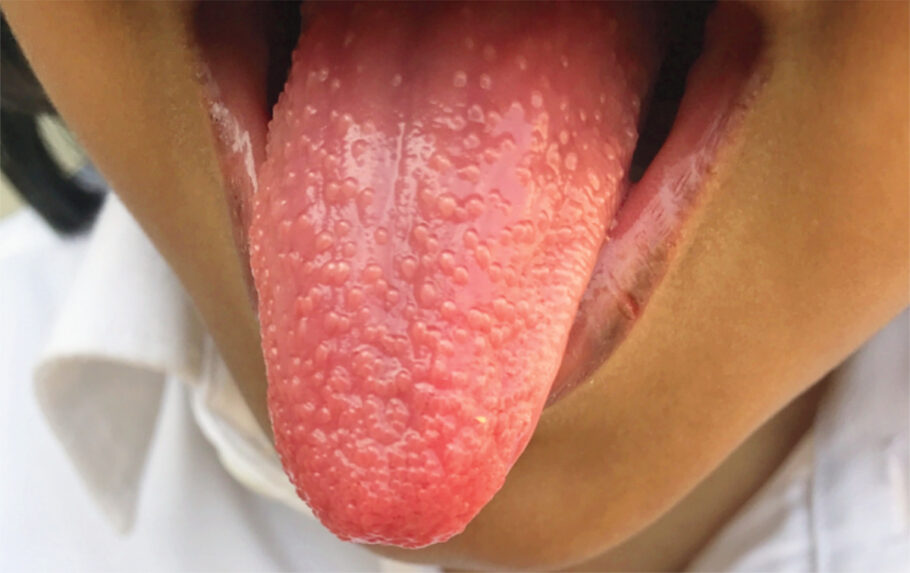 Escarlatina, uma das doenças provocadas pela Strep A, deixa a língua avermelhada com bolinhas