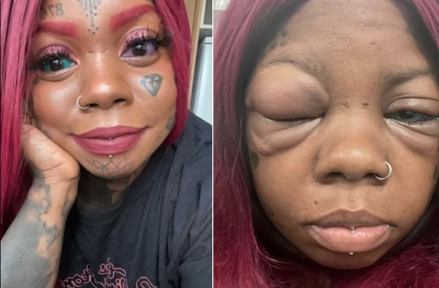 Após tatuagem no globo ocular, mulher pode perder a visão