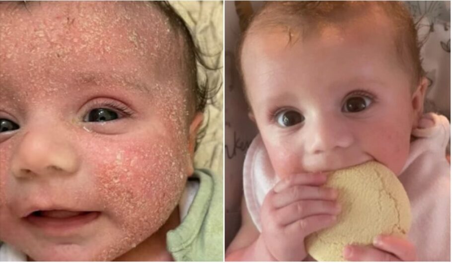 Pais dizem que creme resolveu eczema de bebê em dias