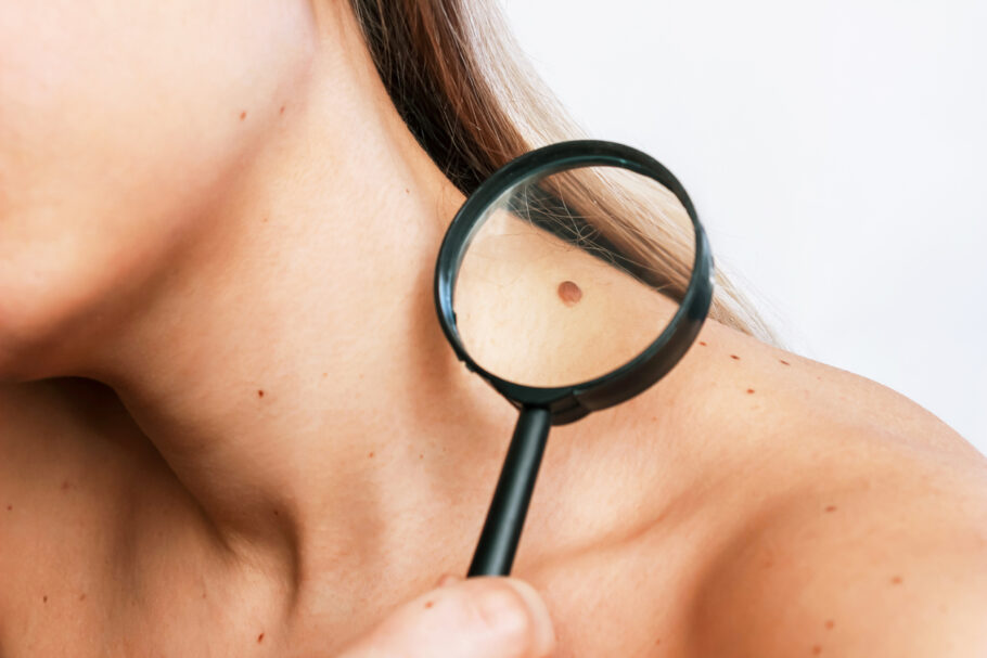 Método “ABCDE” ajuda a identificar sinais de câncer de pele