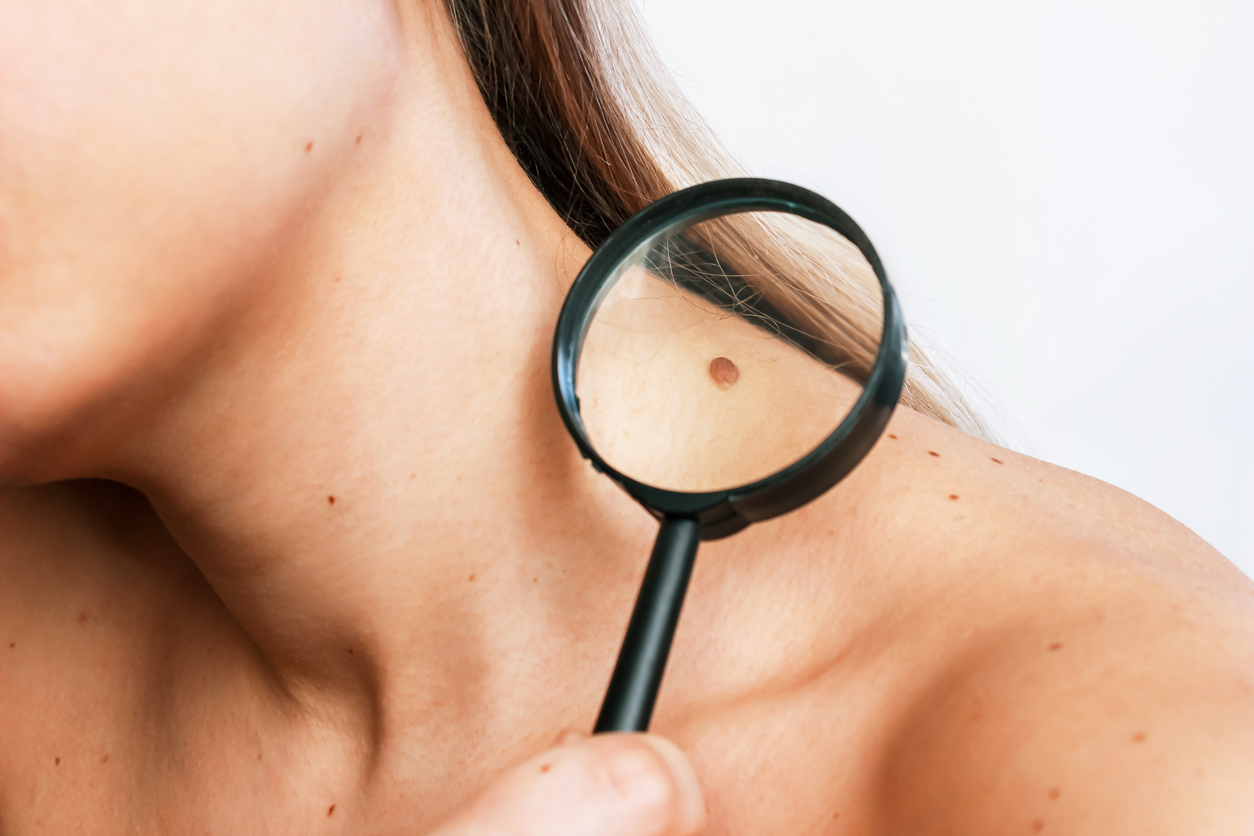 Câncer de pele: conheça os sintomas iniciais e fique alerta
