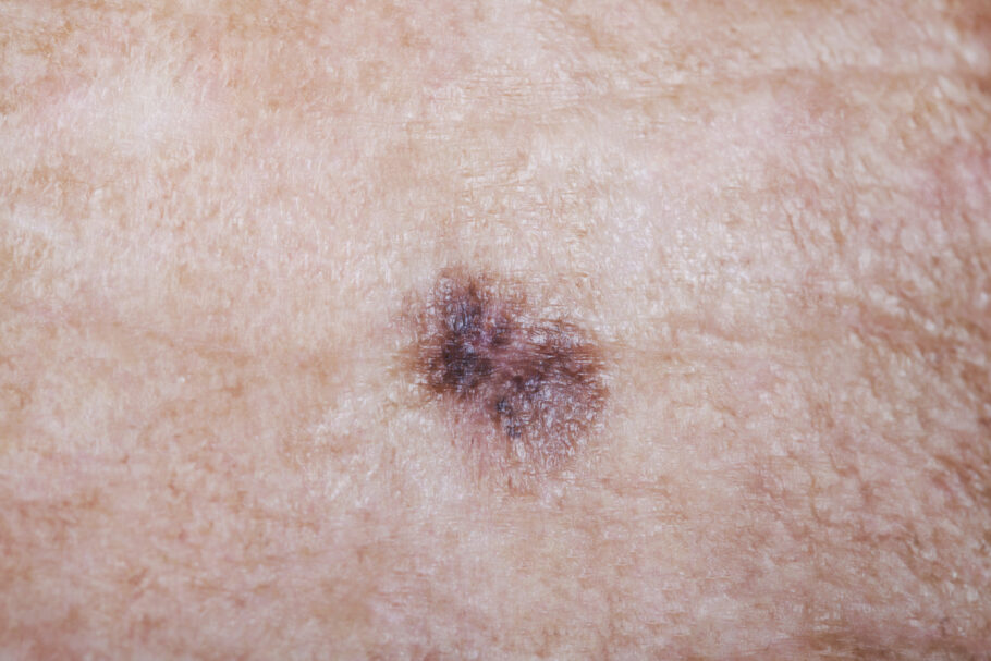 Câncer de pele é o mais frequente no Brasil e no mundo, causado principalmente pela exposição excessiva ao sol