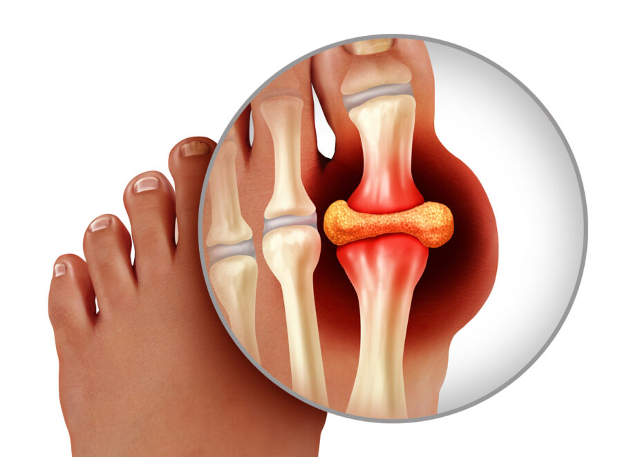 A gota é uma forma de artrite caracterizada por dor, vermelhidão e aumento de volume das articulações