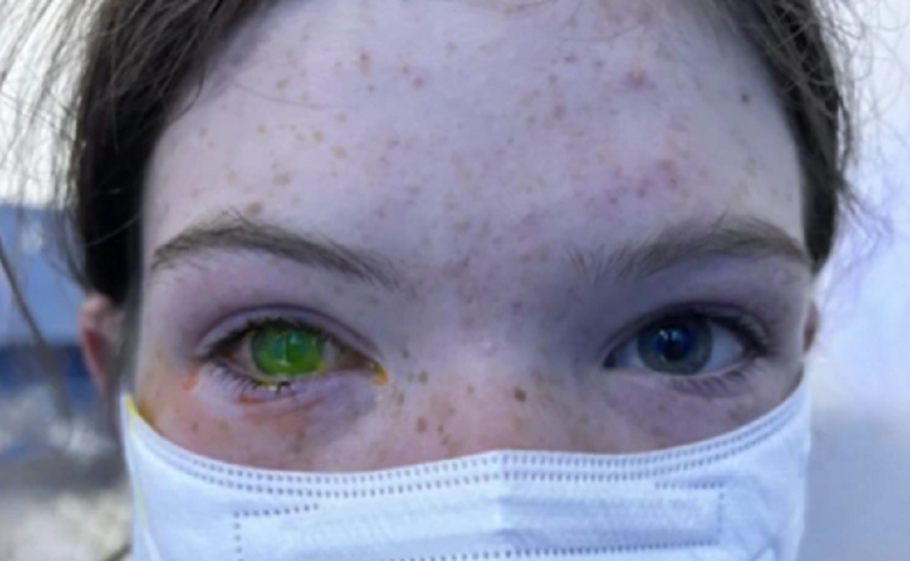 Dezenas de pessoas desenvolvem doença que altera cor da pupila e causa fortes dores