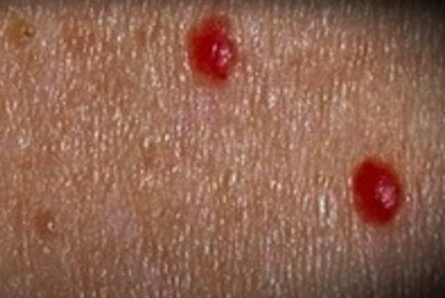 Pintas vermelhas que aparecem na pele são chamadas de nevo rubi ou angioma rubi