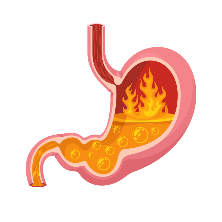Gastrite é uma inflamação do revestimento interno do estômago que pode causar vários sintomas desagradáveis