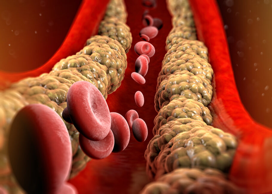 O acúmulo de colesterol no interior das artérias faz elas se estreitarem e entupirem dificultando a passagem do sangue através delas
