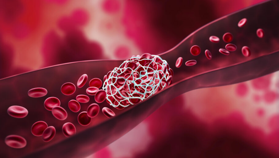 A trombose é a formação de um coágulo sanguíneo em uma ou mais veias, geralmente nas pernas