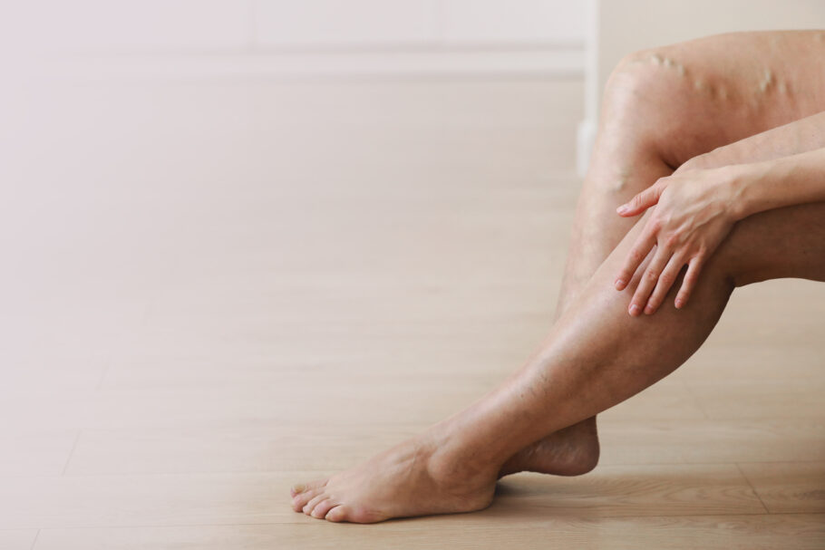 A trombose pode causar inchaços dolorosos, vermelhos e quentes na perna sobre e ao redor do local do coágulo