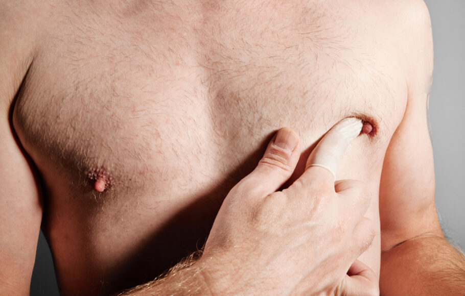 Veja os principais sinais e sintomas do câncer de mama em homens