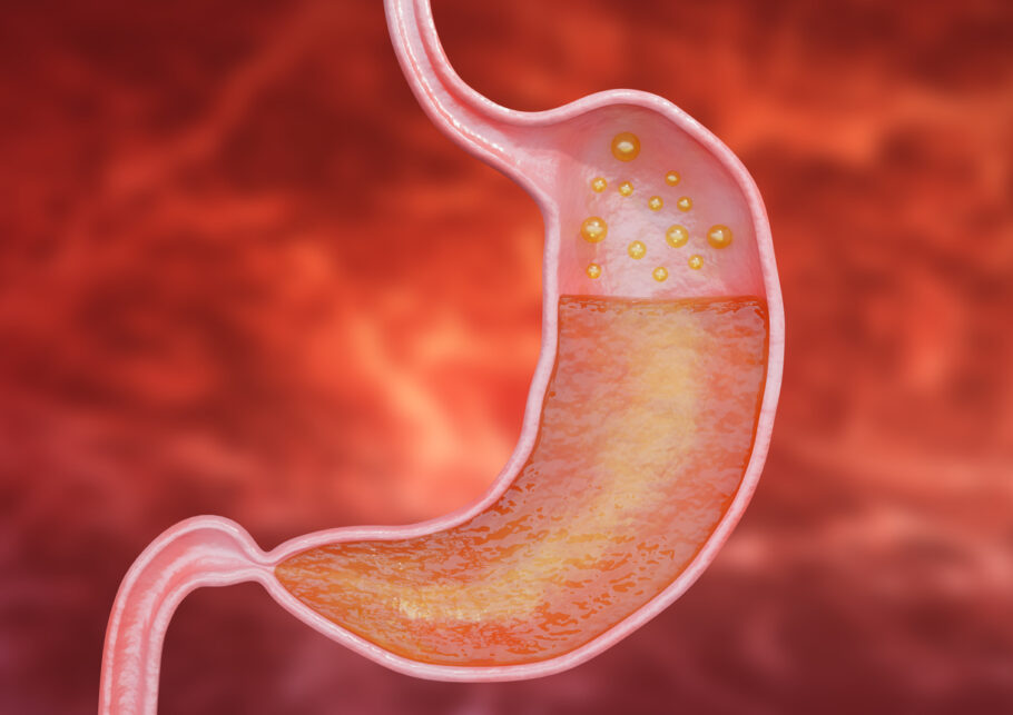 Gastrite é uma inflamação do estomago que pode provocar diferentes sintomas