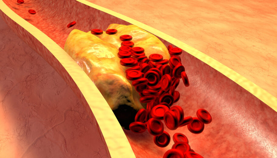Colesterol alto pode levar a problemas de saúde graves, como doenças cardiovasculares