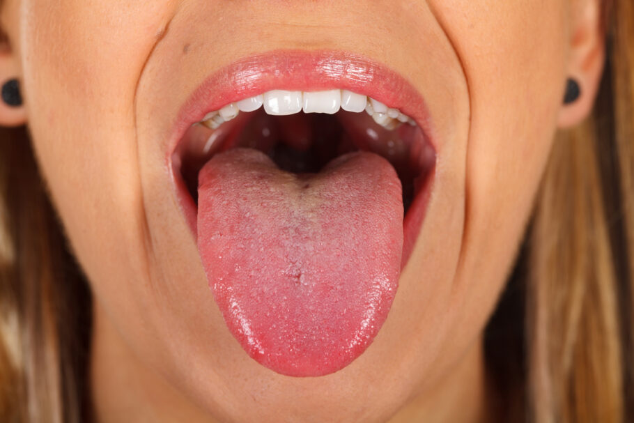 Manchas brancas na língua precisam ser acompanhadas pois há risco de evoluírem para um câncer de boca