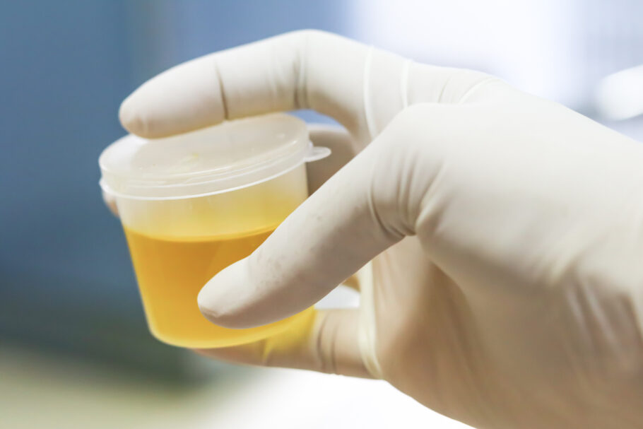 Exame de urina ajuda a detectar a doença