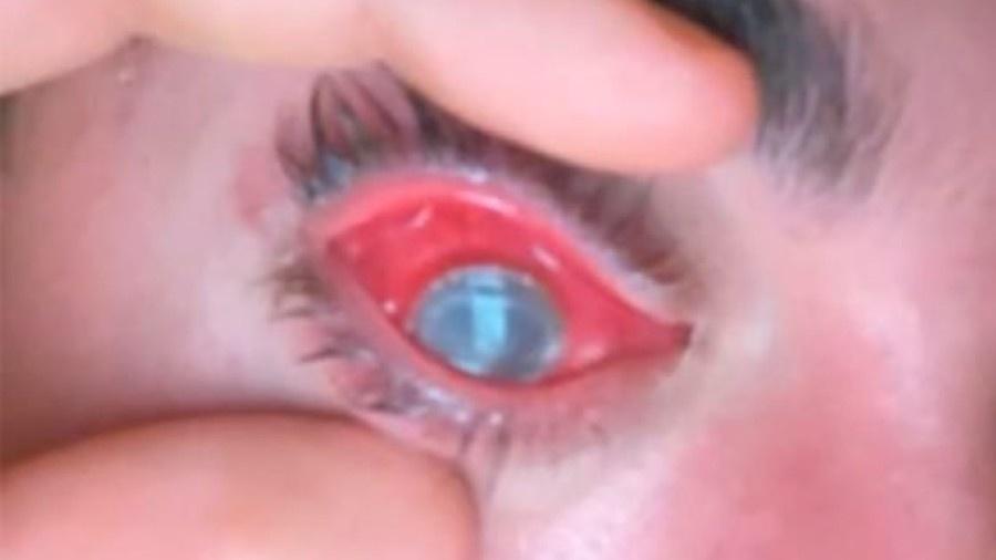 Infecção ocular provoca dor e vermelhidão nos olhos