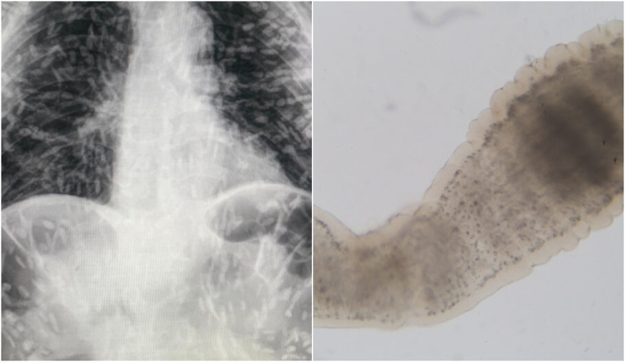 Cisticercose – as larvas ingeridas caem na corrente sanguínea e podem chegar em diferentes partes do corpo