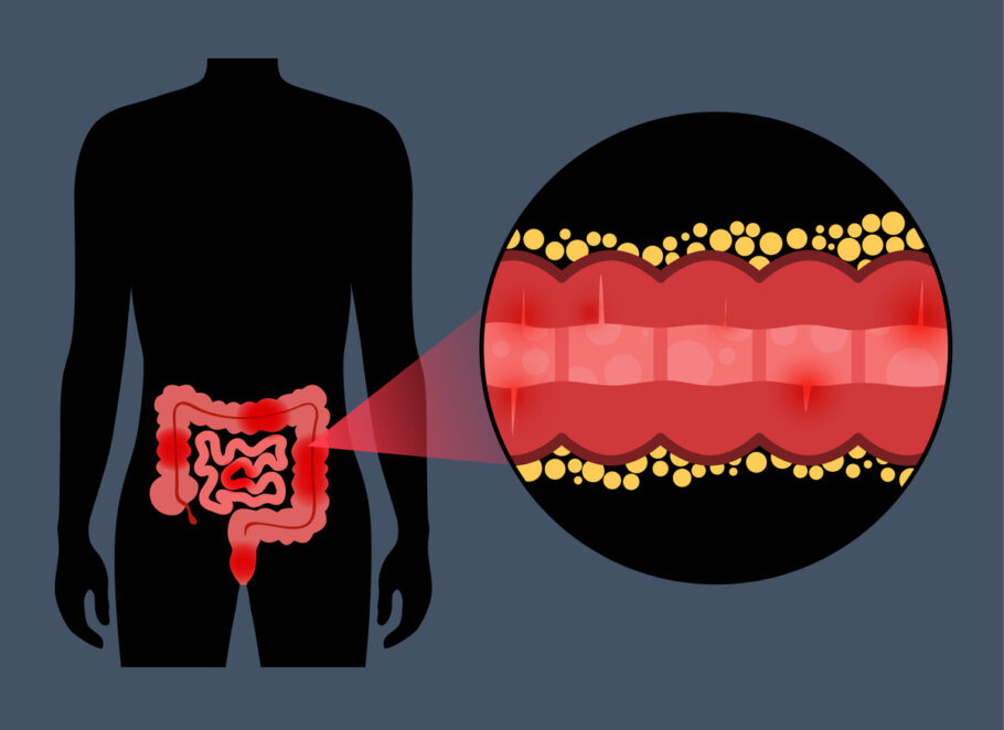 Conheça os sintomas da doença de Crohn