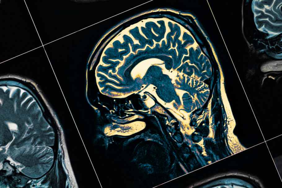 Novo medicamento retarda o declínio cognitivo e funcional em pessoas com doença de Alzheimer em 35%