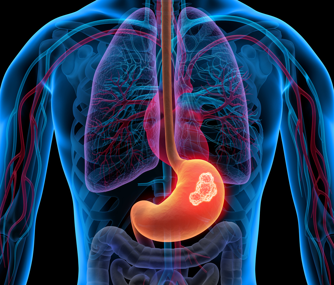 Os sintomas de câncer de estômago são inespecíficos, alertam estudos sobre o tema – iStock/Getty Images